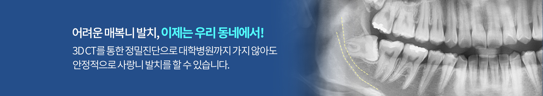 어려운 매복니 발치, 이제는 우리 동네에서