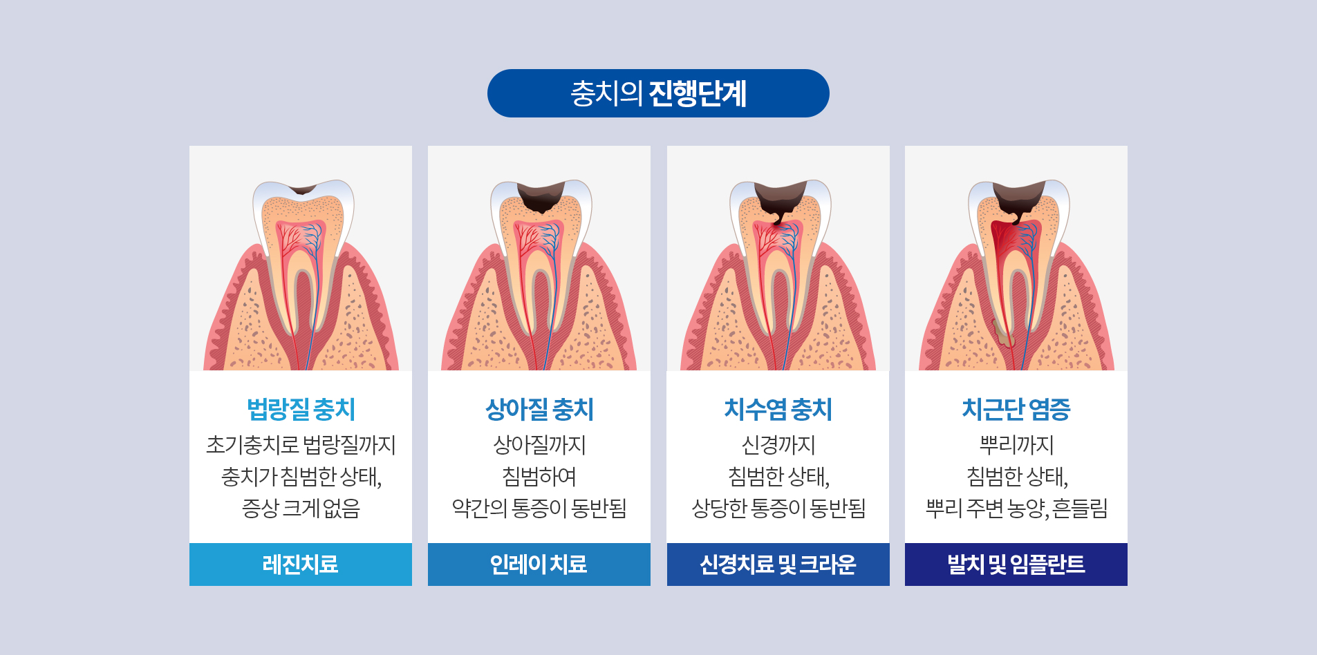 충치의 진행단계