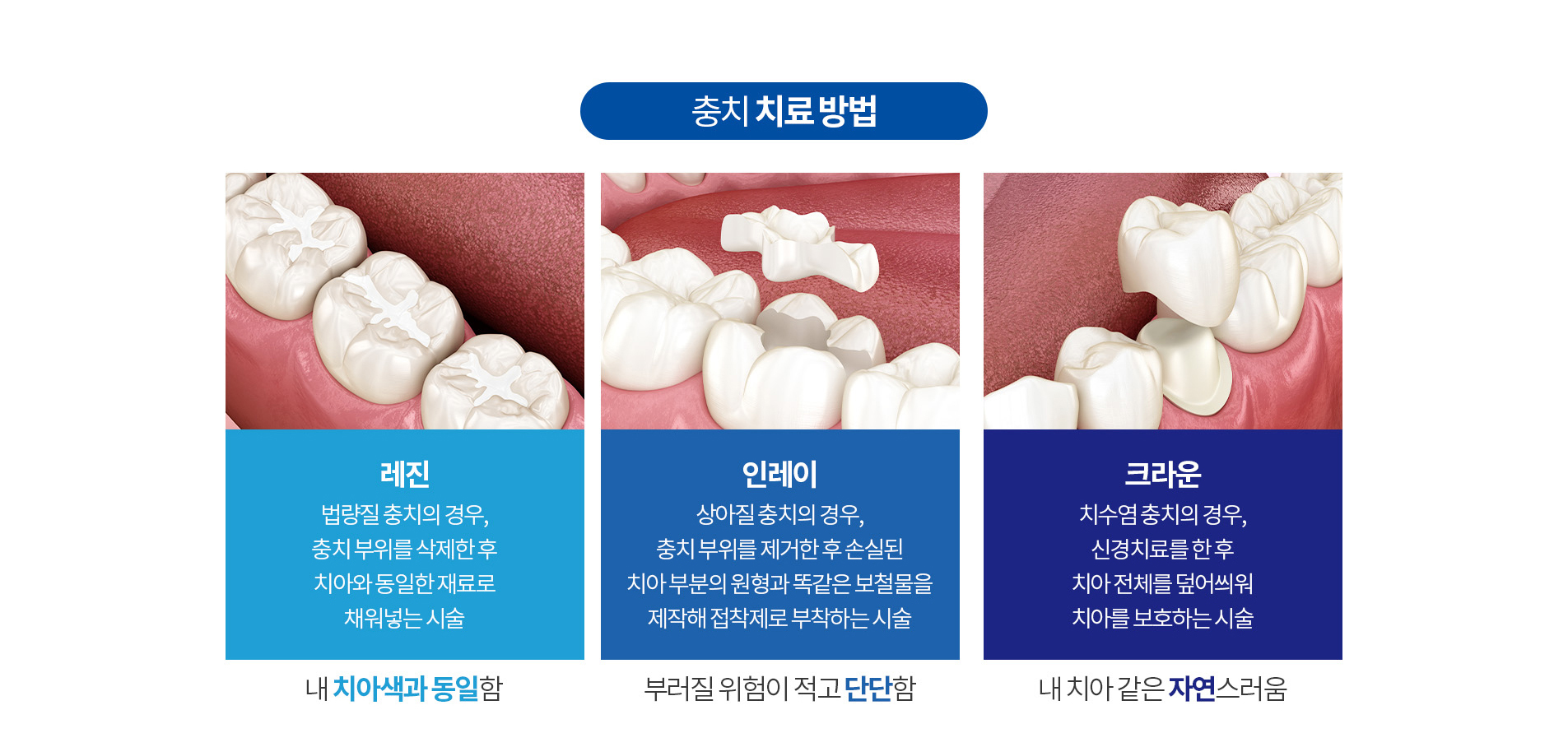 충치 치료방법