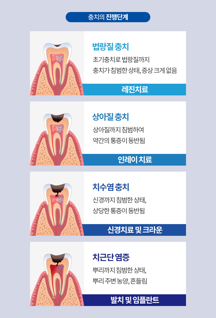 충치의 진행단계